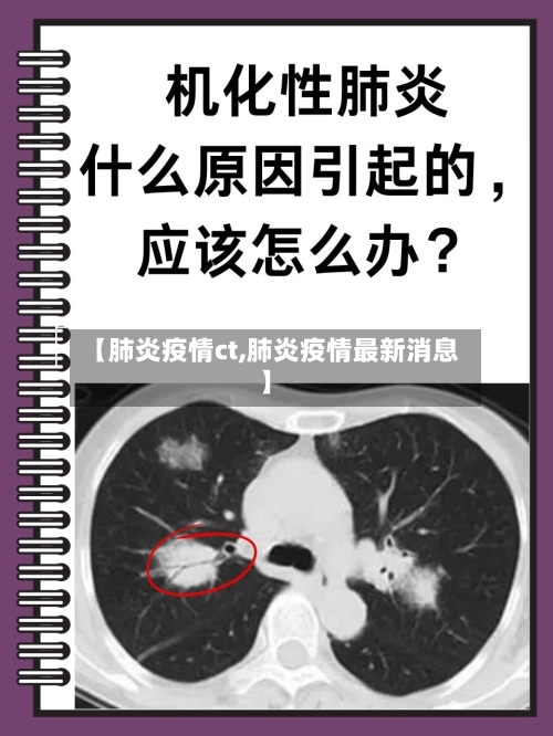 【肺炎疫情ct,肺炎疫情最新消息】-第3张图片