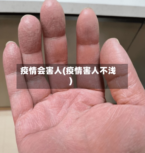 疫情会害人(疫情害人不浅)-第2张图片